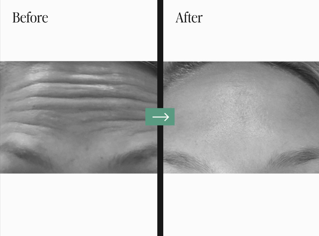 Botox Before and After Pictures Charleston, SC